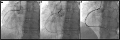 The Use of Bumper Wire Technique and Intravascular Ultrasound for Precise Aorto-Ostial Stenting